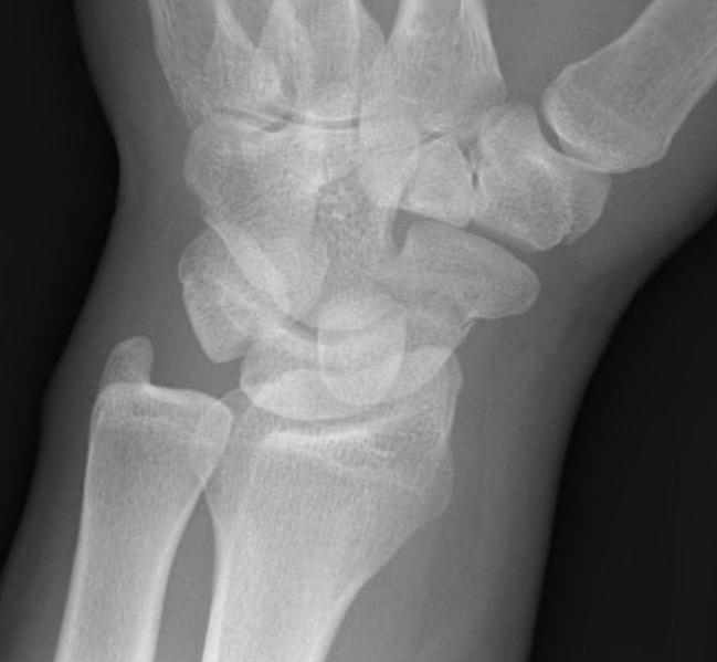 Scaphoid Fracture Oblique